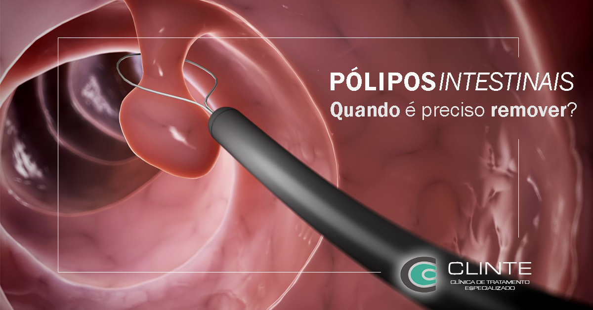 Pólipos Intestinais – Quando é preciso remover? – Clínica Clinte Itajaí/SC