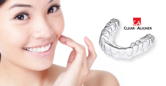 CA ® Clear Aligner – tratamento ortodôntico mais discreto