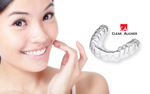 CA ® Clear Aligner – tratamento ortodôntico mais discreto